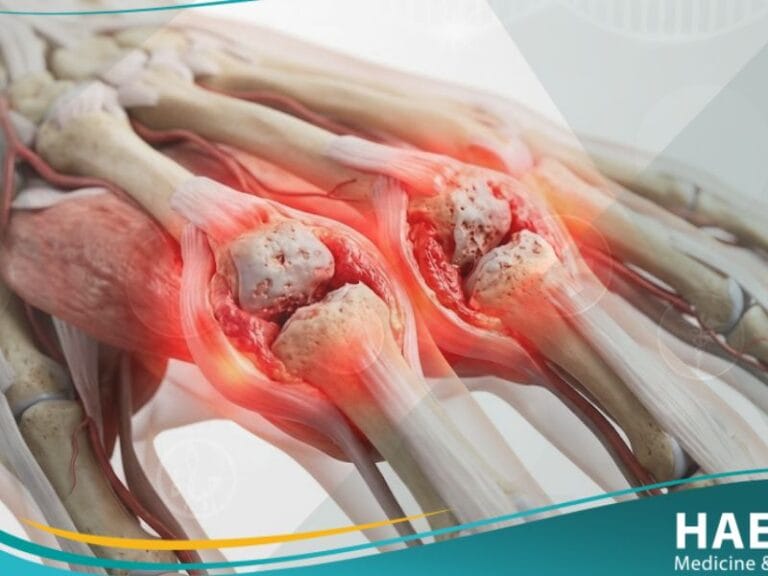 _التهاب المفاصل الروماتويدي