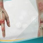 التهاب المفاصل الصدفي (1)