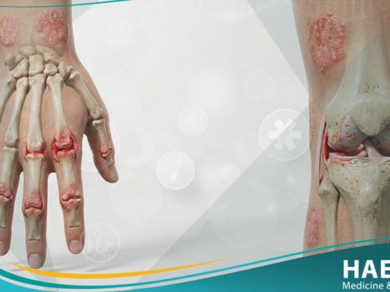 التهاب المفاصل الصدفي (1)