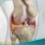 التهاب المفصل الإنتاني