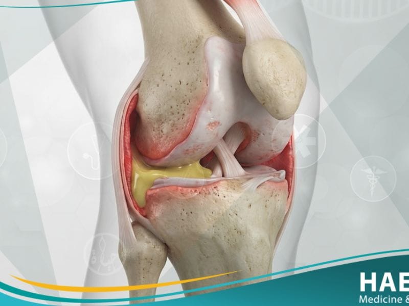 التهاب المفصل الإنتاني