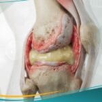 التهاب المفصل العدوائي