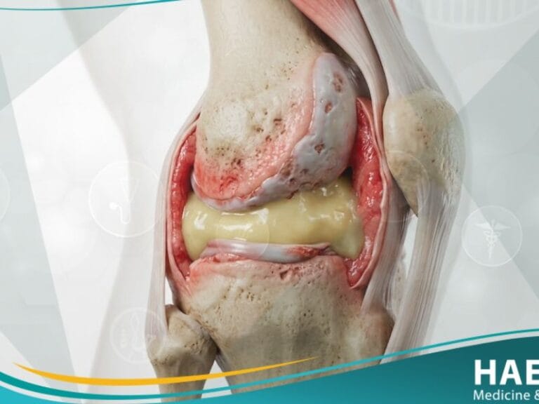 التهاب المفصل العدوائي