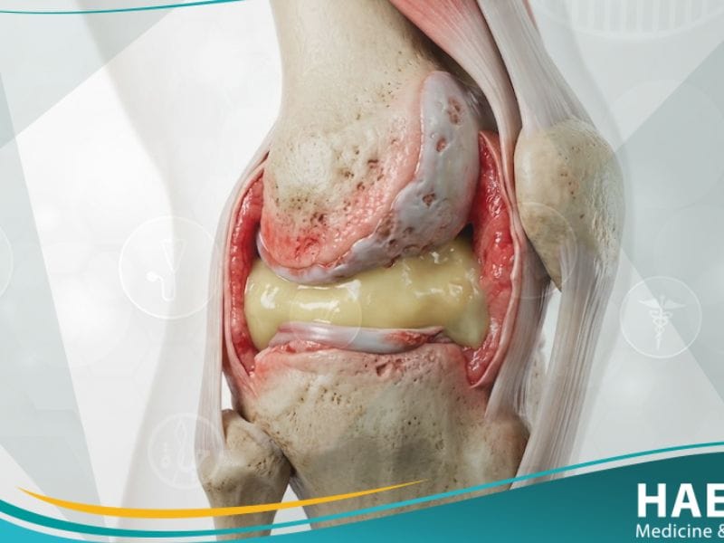 التهاب المفصل العدوائي