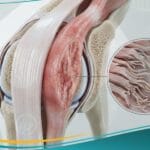 التهاب الوتر