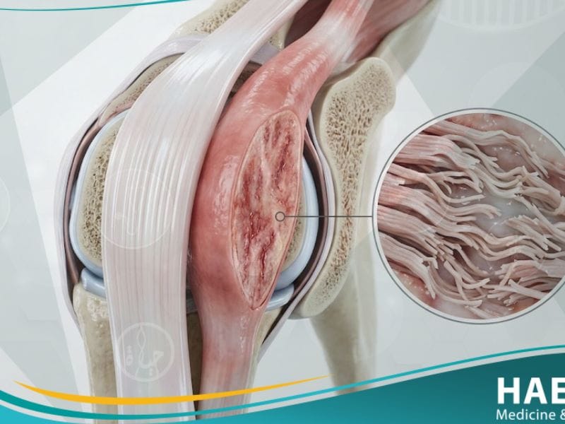 التهاب الوتر