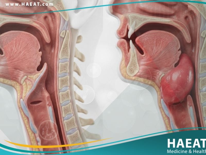 التهاب لسان المزمار