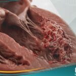 الخثرة الجدارية