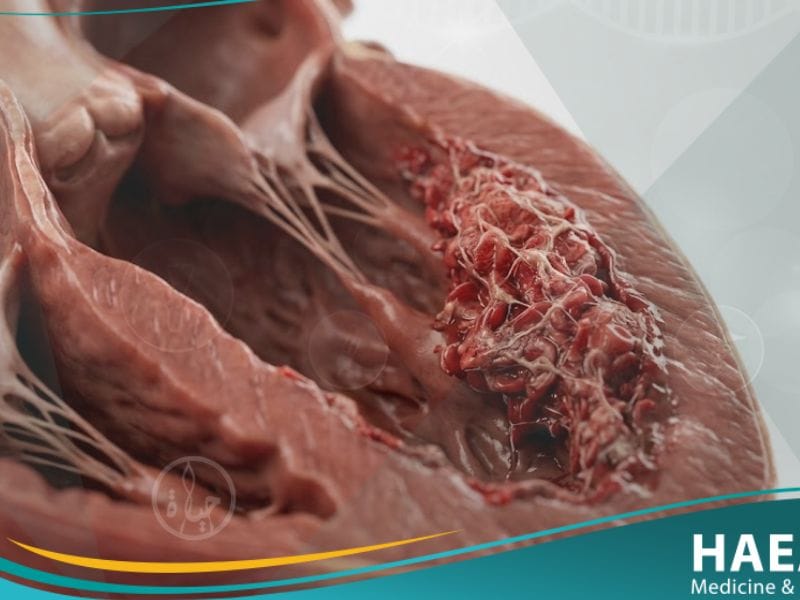 الخثرة الجدارية