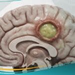 الخراج الدماغي