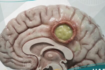 الخراج الدماغي