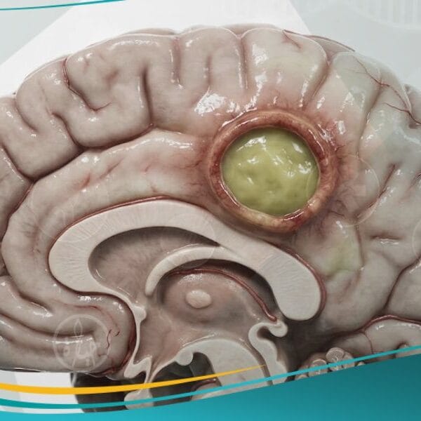 الخراج الدماغي