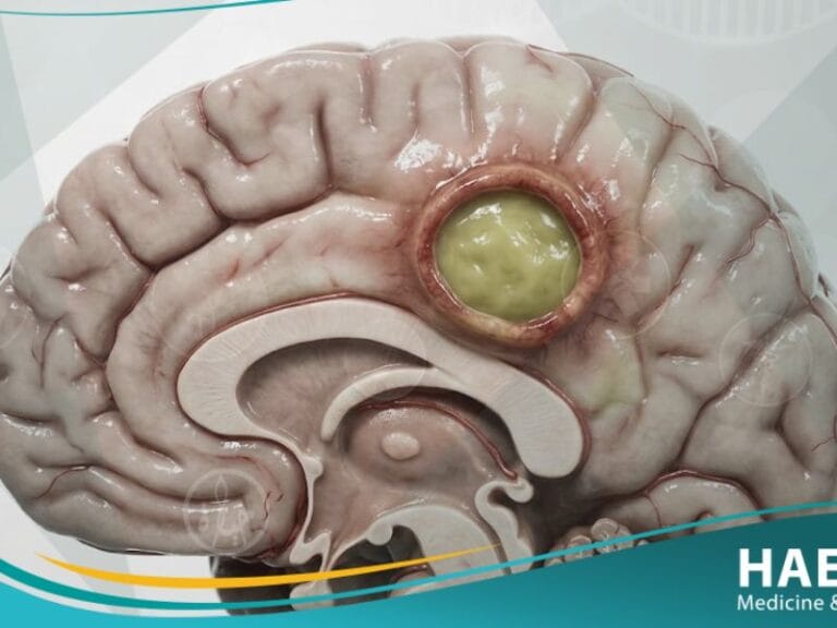 الخراج الدماغي
