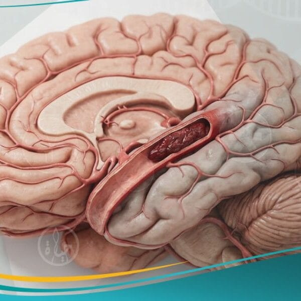 السكتة الدماغية