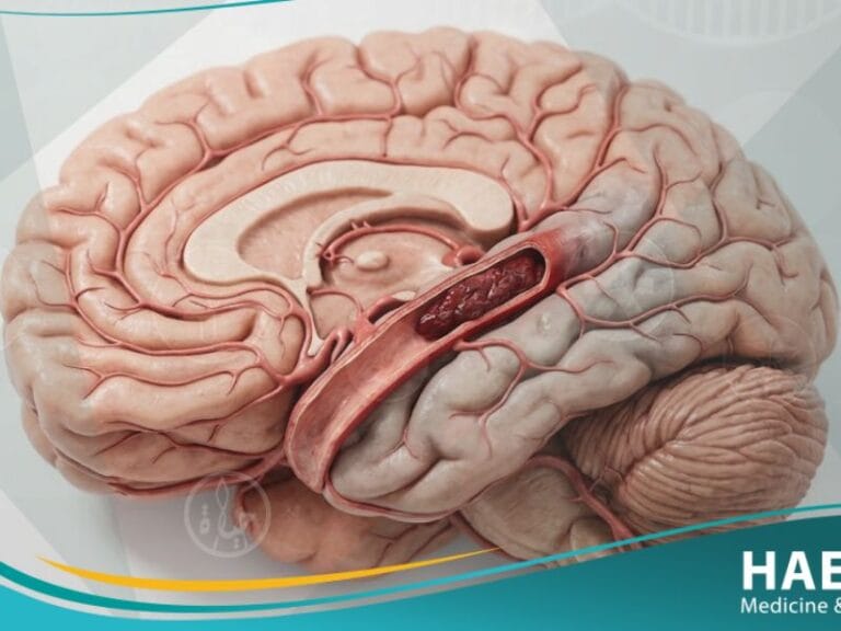 السكتة الدماغية