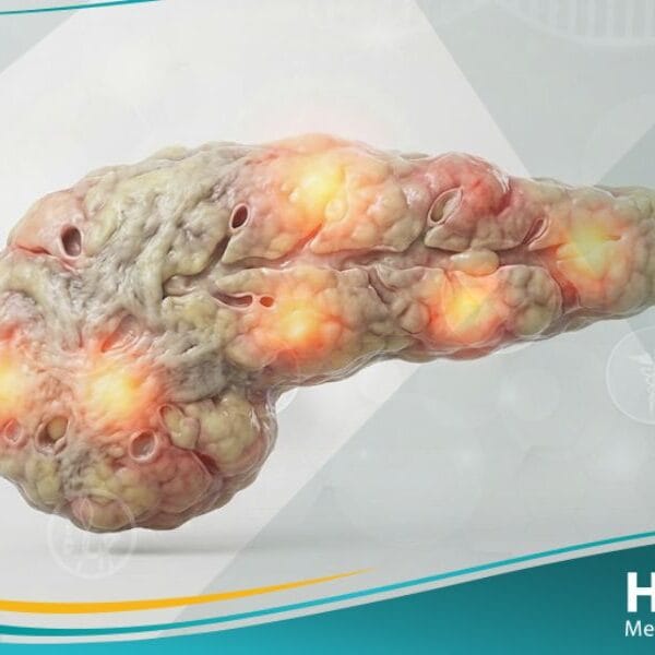 _السكري الناتج عن حالات خاصة