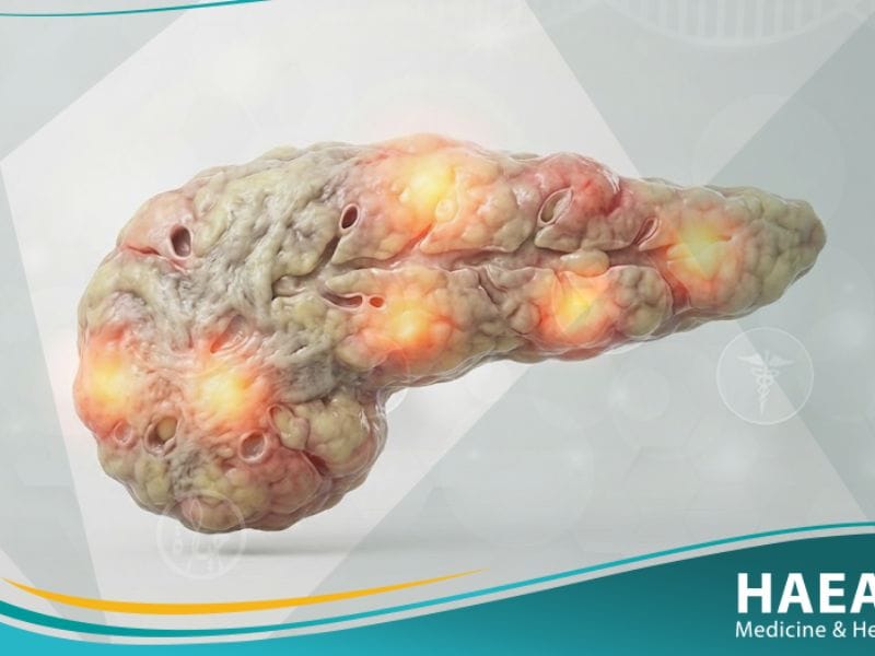 _السكري الناتج عن حالات خاصة