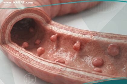 _السلائل في الجهاز الهضمي لدى الأطفال