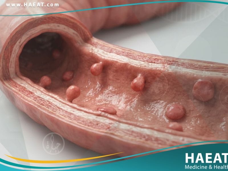 _السلائل في الجهاز الهضمي لدى الأطفال