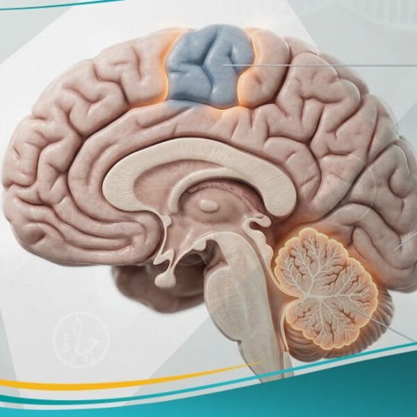 الشلل الدماغي