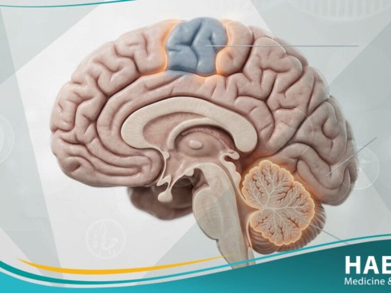 الشلل الدماغي