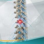 الشلل السفلي