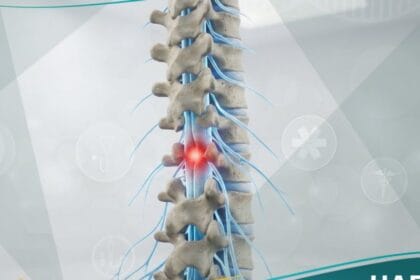 الشلل السفلي