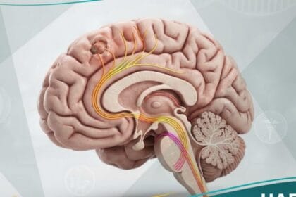 الشلل النصفي