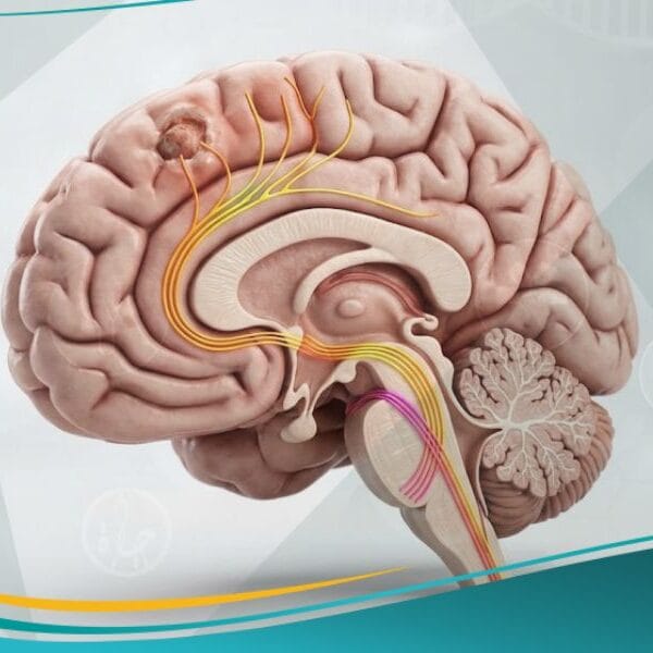 الشلل النصفي