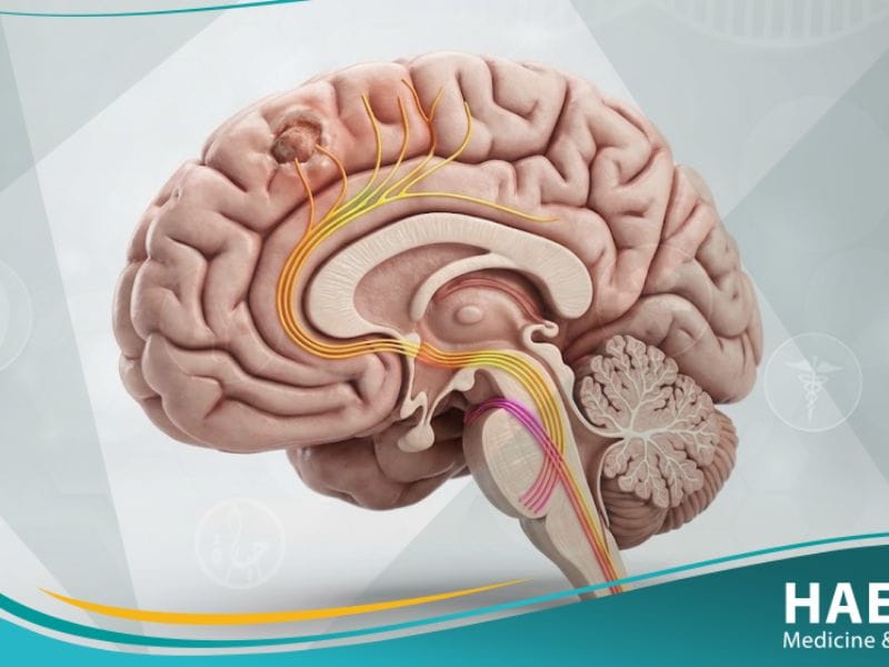 الشلل النصفي