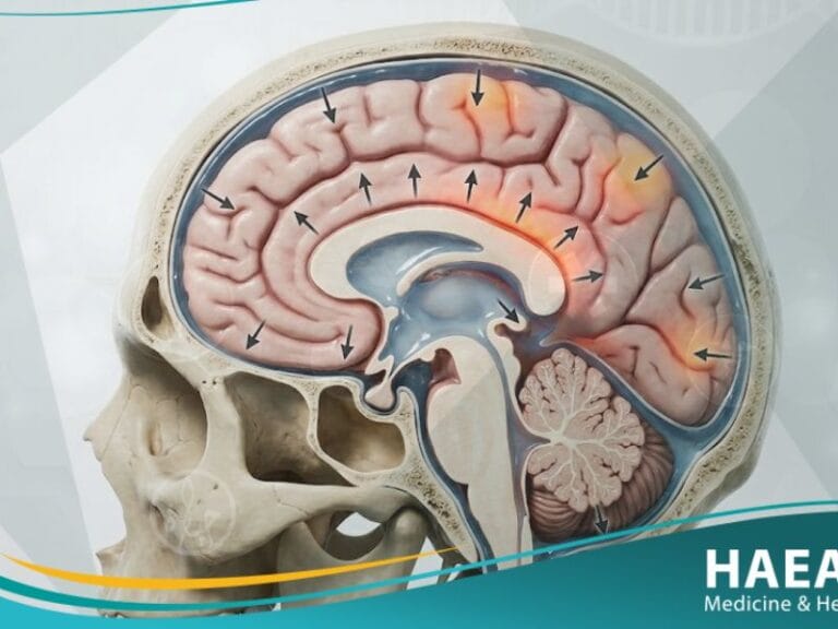 الضغط داخل القحف