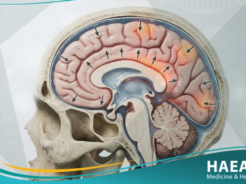 الضغط داخل القحف