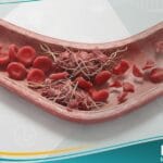 الفرفرية القليلة الصفيحات الخثارية (1)