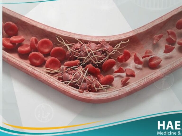 الفرفرية القليلة الصفيحات الخثارية (1)