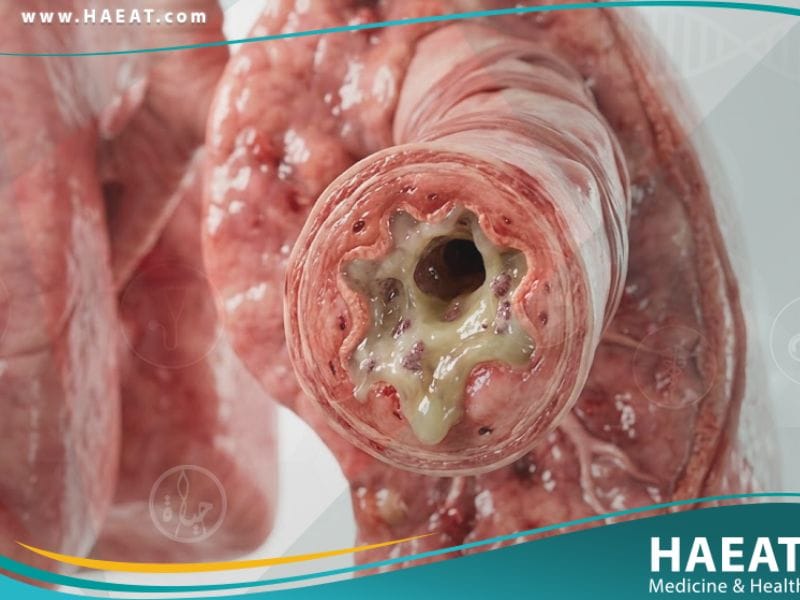 _الفيروس المخلوي التنفسي