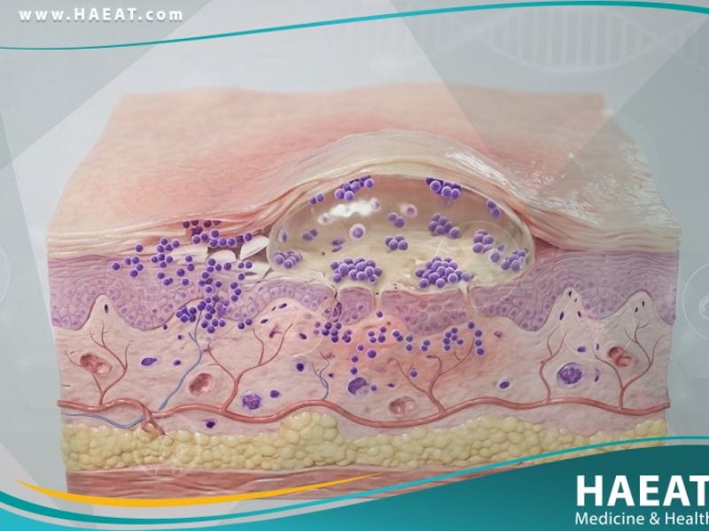 القوباء الوليدية