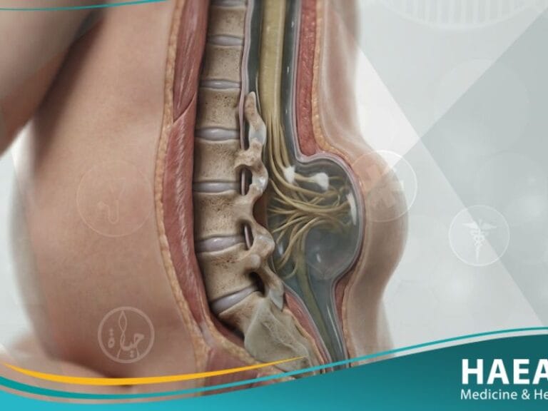 _القيلة النخاعية السحائية