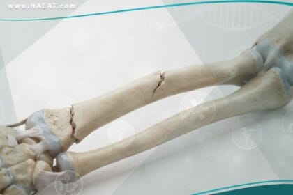 الكسور الشائعة لدى الأطفال