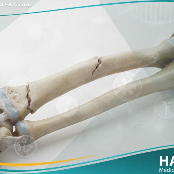 الكسور الشائعة لدى الأطفال