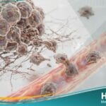 النقائل السرطانية