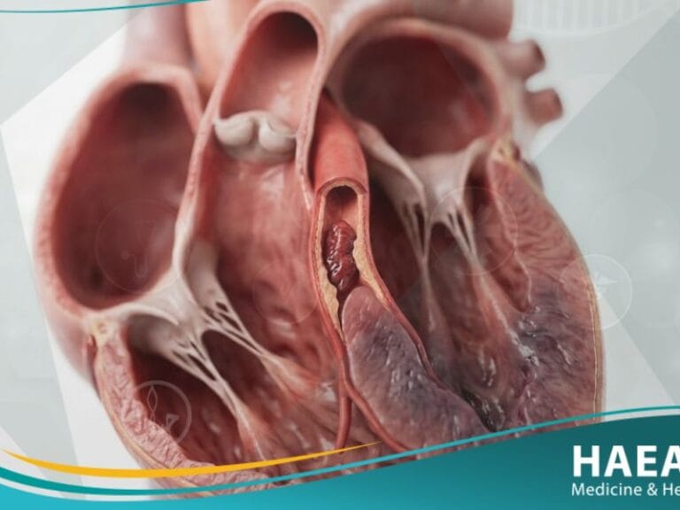 النوبة القلبية