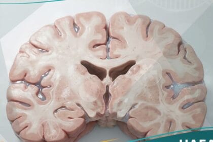 الوذمة الدماغية