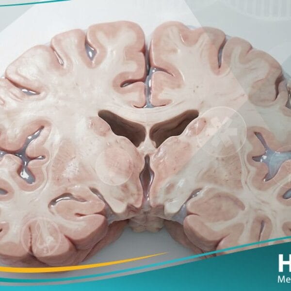 الوذمة الدماغية