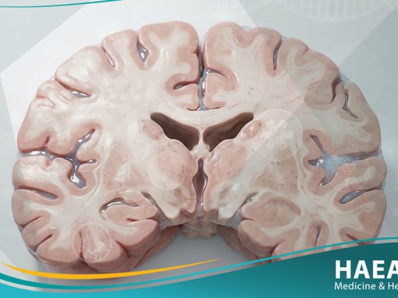 الوذمة الدماغية