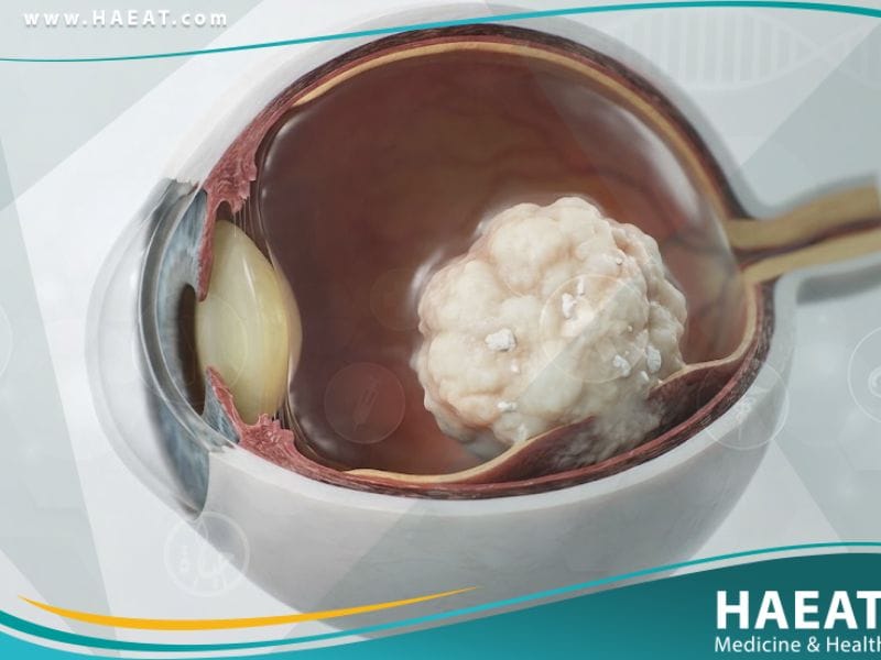 الورم الأرومي الشبكي