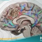 الورم الدبقي