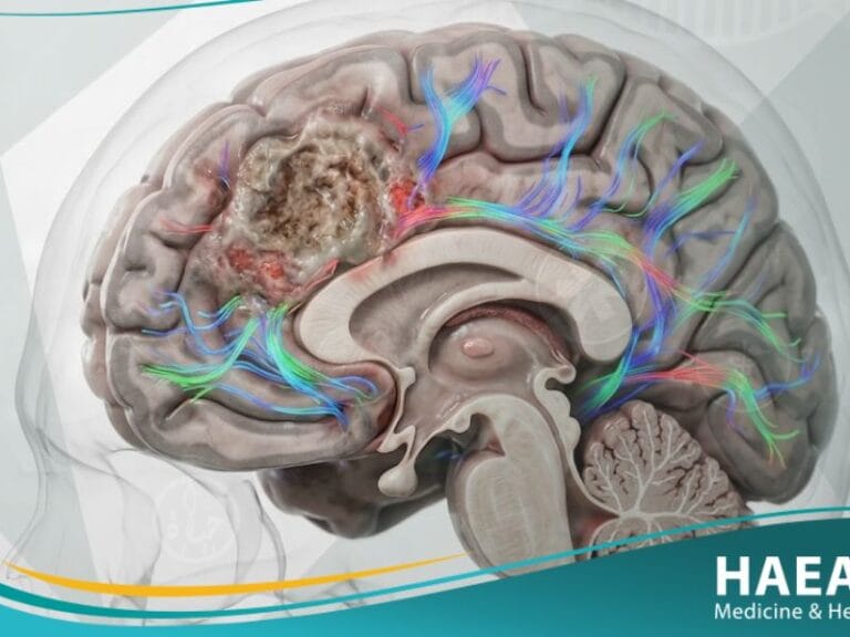 الورم الدبقي