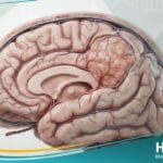 الورم السحائي