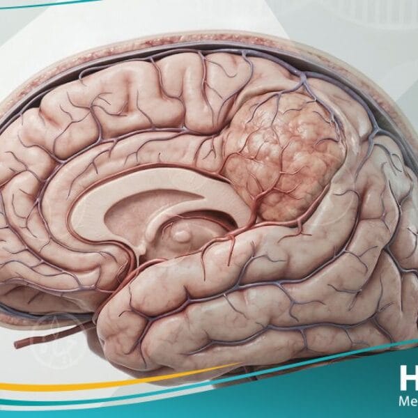 الورم السحائي