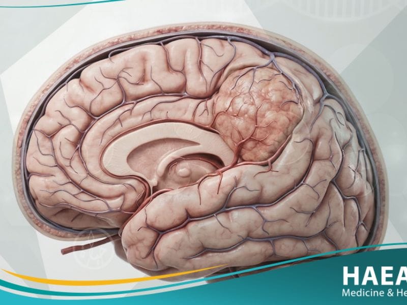 الورم السحائي